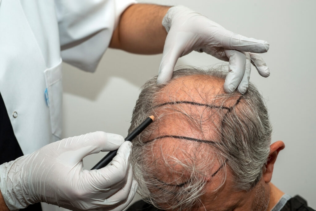 vergiyi boyle kacirmislar sac ekimi yapan doktor yilda 69 milyon tllik kazancini gizlemis jv3MQ8wg