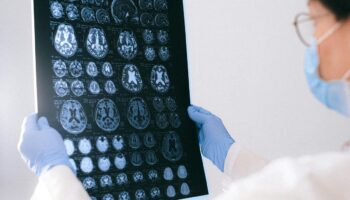 bilim insanlari alzheimerin beyin hucresi olumune yol acan temel proteini belirledi SaN47lKR
