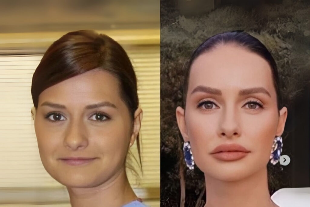 yasemin ozilhan sadece dudagimda dolgu var kiG7Zf4f