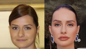 yasemin ozilhan sadece dudagimda dolgu var kiG7Zf4f