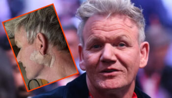 unlu yemek sefi gordon ramsay cilt kanserini erken teshisle atlatti qAydelcZ