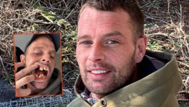 dislerindeki bozukluk nedeniyle at agizli olarak anilan adam turkiyedeki tedavinin ardindan sasirtici bir gorunume NKye2JGd